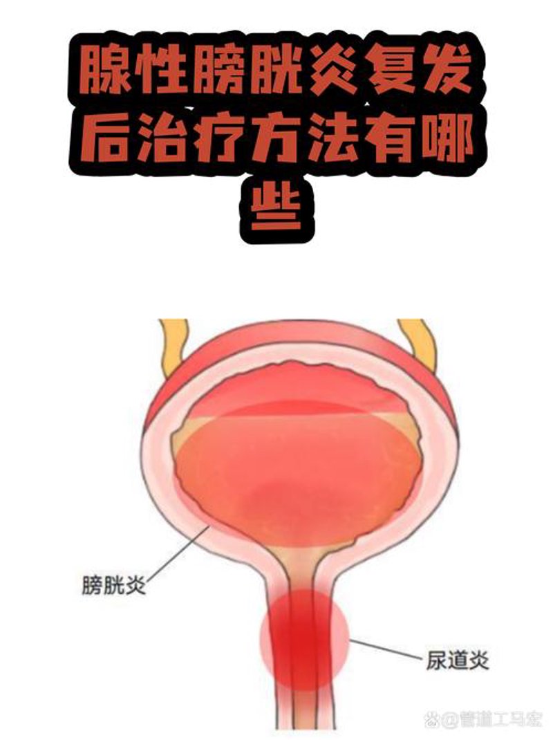 前列腺炎治疗